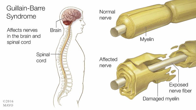 Understanding Guillain-Barre Syndrome