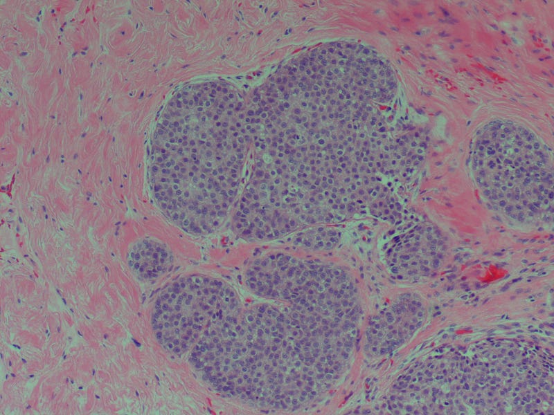 Photomicrograph of ductal carcinoma in situ